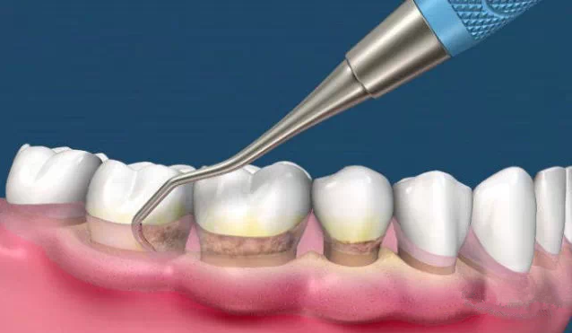 龈下刮治后的牙面及牙根光滑,大大降低了牙周袋内细菌的数量.