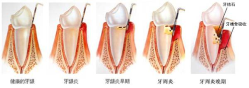 刘智 请重视牙周病 图片2.png